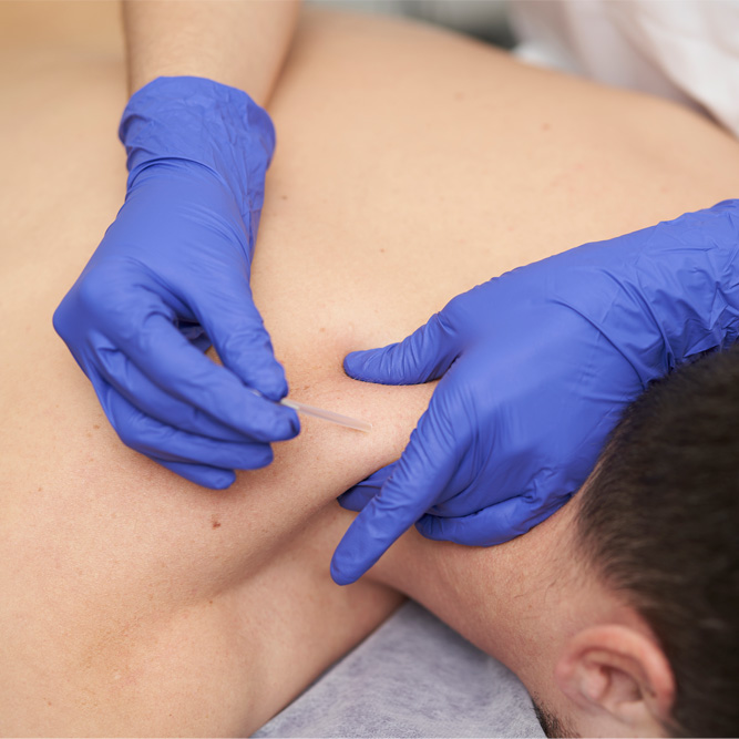 Dry needling bij patiënt
